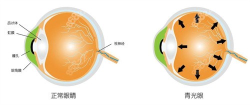 正常眼睛和青光眼