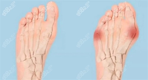 拇外翻手術(shù)選李昕宇還是蘇敬達還是溫健民？三位小創(chuàng)口技術(shù)各有千秋