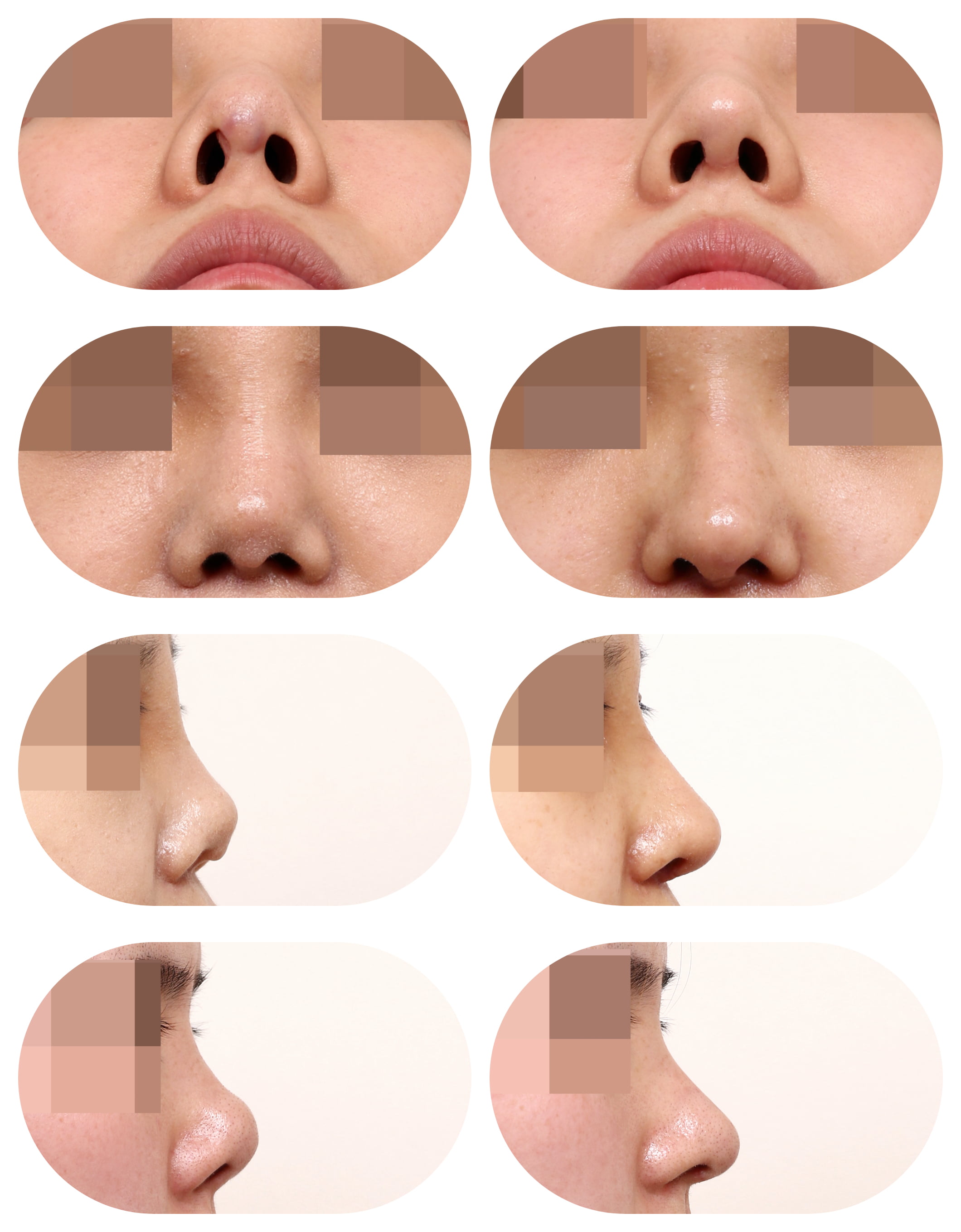 三、骨膠原鼻子一旦用了就不能停嗎怎么辦？科學(xué)補打與替代方案全攻略