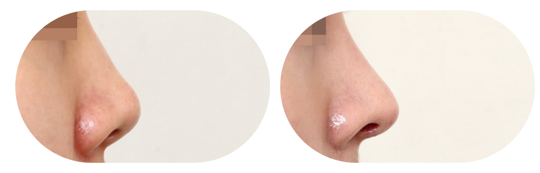 六、骨膠原鼻子補打&護理全指南，讓成效維持更久