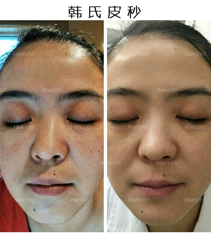 沈陽哪個醫(yī)院祛斑靠譜？2026年七院、杏林、百嘉麗等多家醫(yī)院祛斑價1100-14800元不等