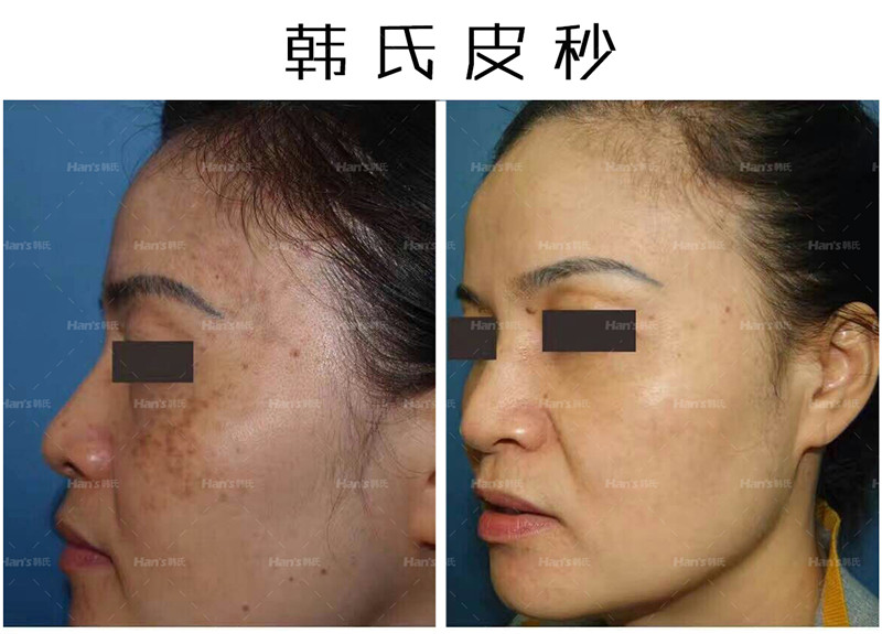 二、沈陽(yáng)七院皮膚科祛斑實(shí)力如何？