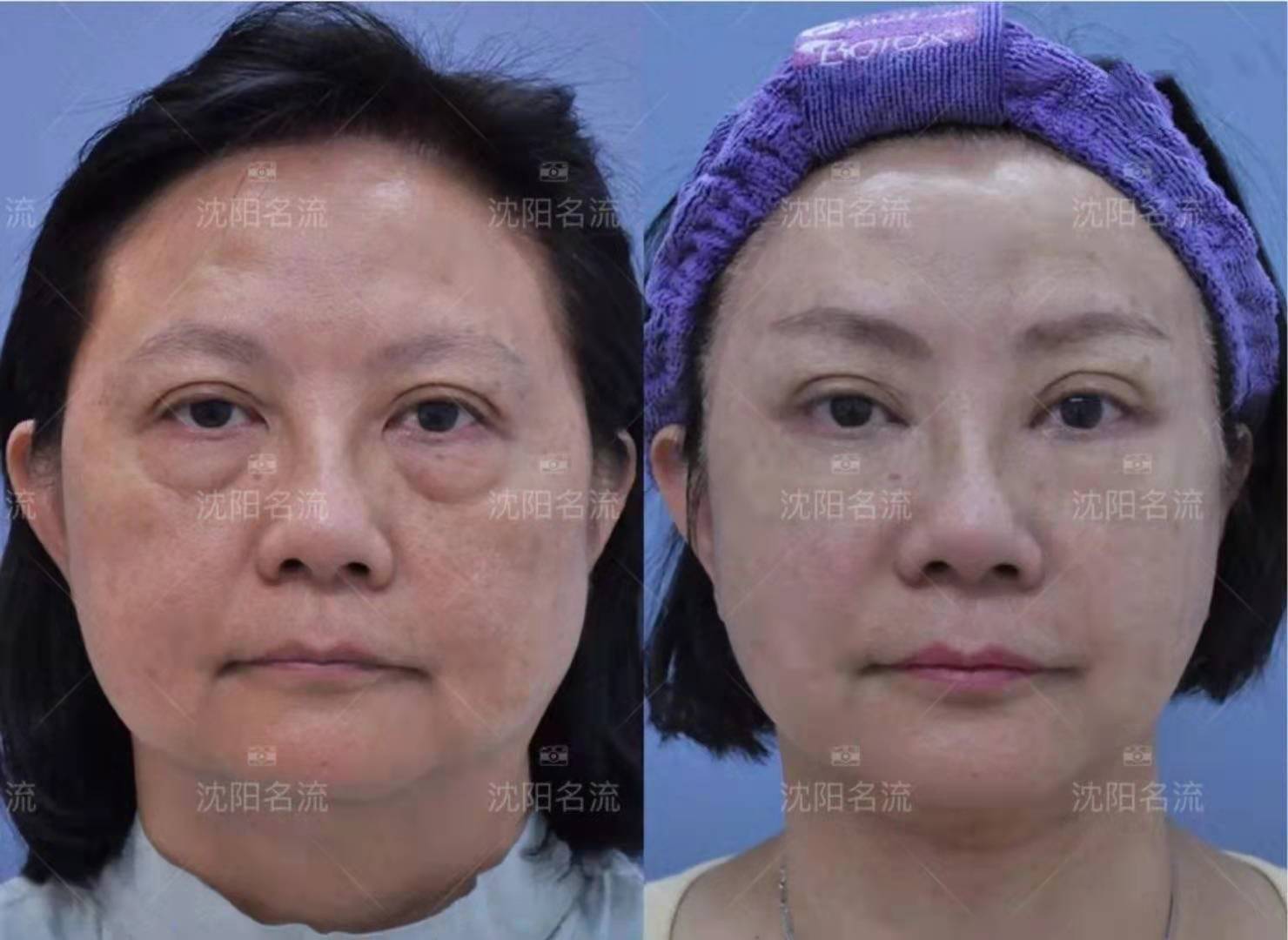 三、杜太超醫(yī)生拉皮手術(shù)價(jià)格優(yōu)勢(shì)m.sorencai.cn