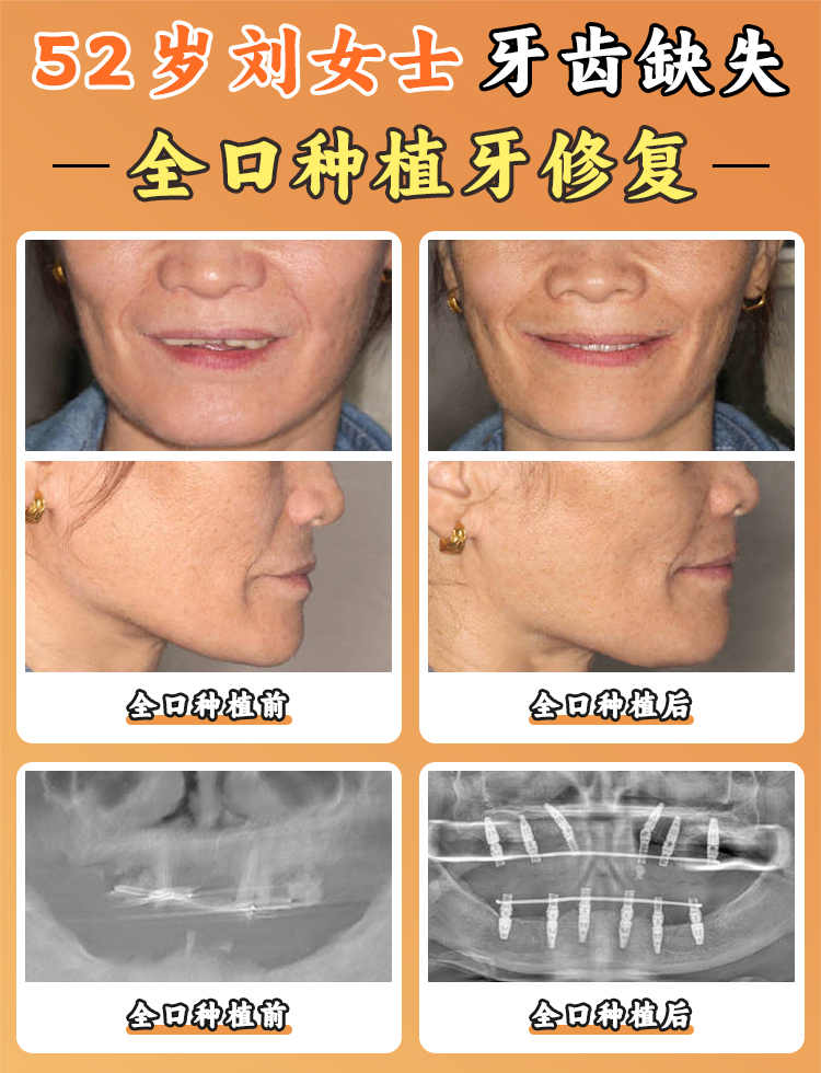 滬申口腔醫(yī)院種植牙收費(fèi)合理m.sorencai.cn