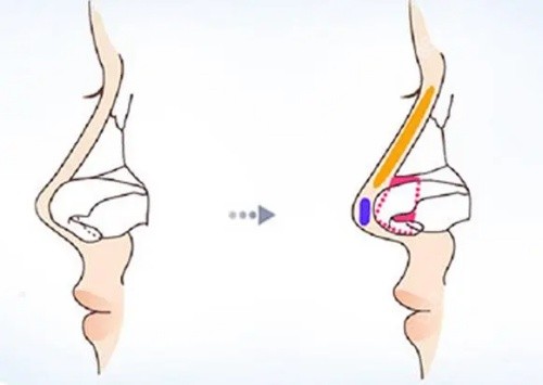 鼻小柱延長(zhǎng)結(jié)構(gòu)示意圖