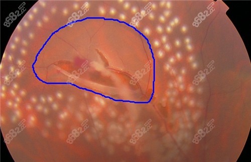 視網(wǎng)膜脫落細節(jié)圖片