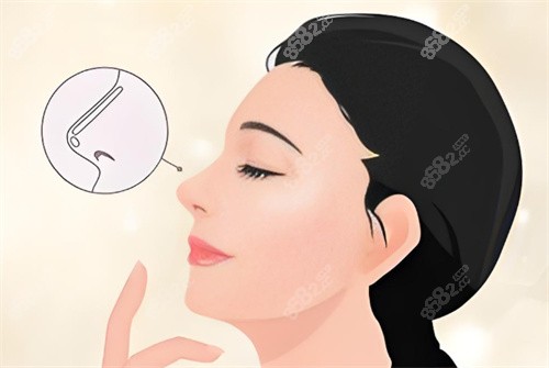 假體隆鼻卡通圖