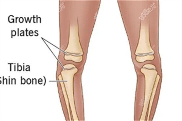 O型腿的樣子圖解