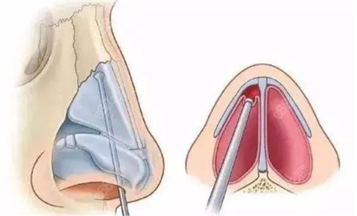 鼻梁鼻尖剖面圖