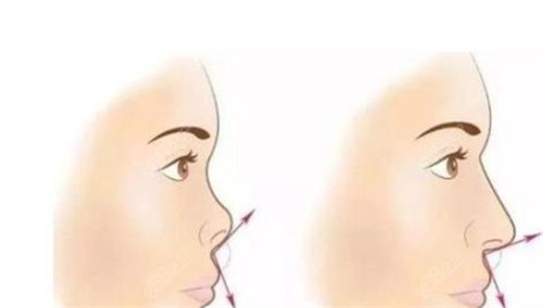 隆鼻前后對(duì)比示圖