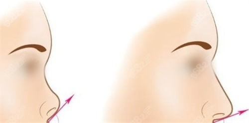 隆鼻手術(shù)鼻尖角度調(diào)整前后對(duì)比圖