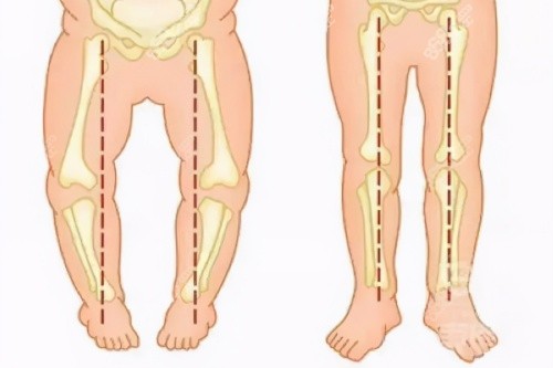 O型腿與正常腿型對比圖