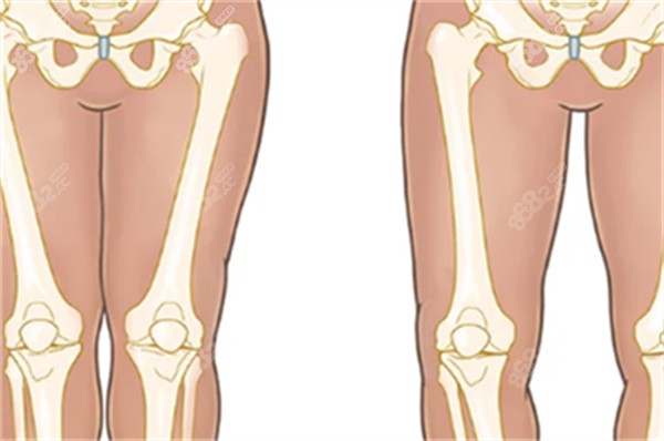 O型腿和直腿的區(qū)別圖解