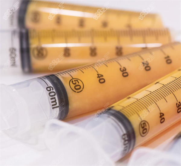 填充O型腿所需的自體脂肪圖解