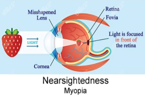 近視視物落在視網(wǎng)膜前