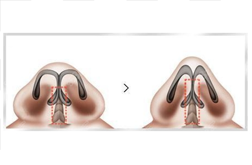 鼻小柱延長(zhǎng)手術(shù)改善剖面圖