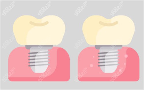 種植牙對(duì)比圖