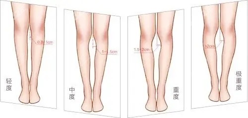 腿型矯正對比圖