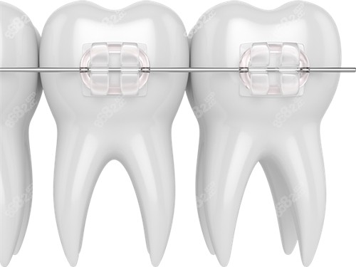 牙齒矯正陶瓷托槽漫畫圖