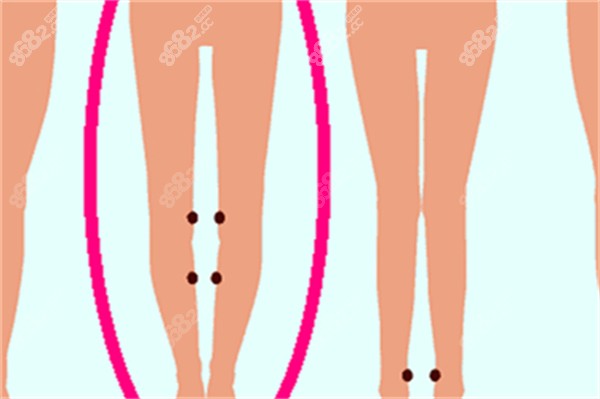 輕微O型腿的樣子