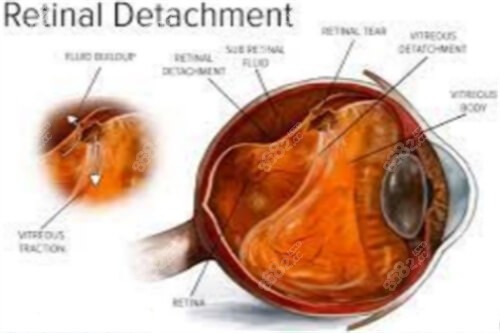 視網(wǎng)膜脫離示意圖