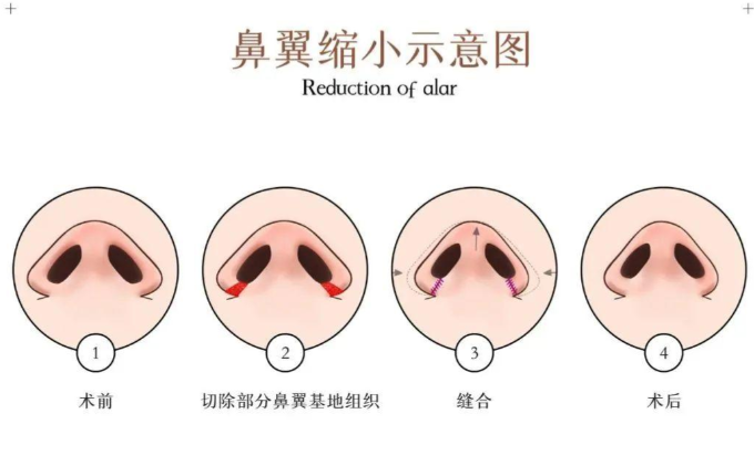 二、重庆鼻翼缩小怎么选才能不踩坑？先在美卫士看素人日记