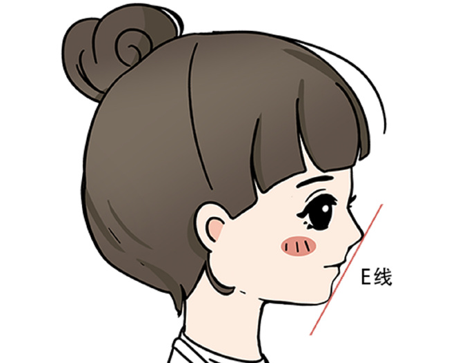 下頜角截骨——塑造柔和線條的關鍵