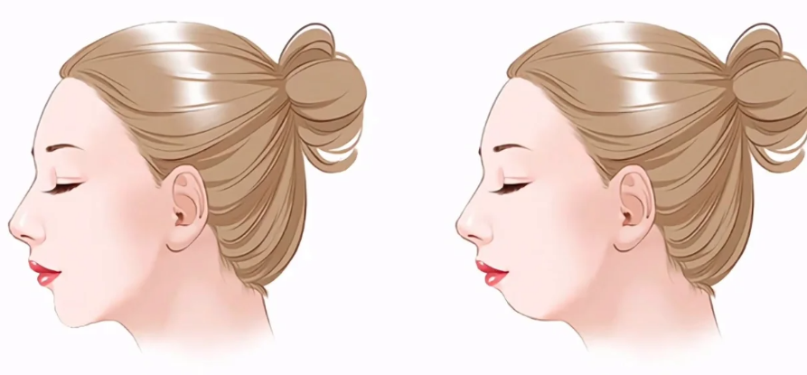 頦成型：決定臉型比例的“點睛之筆”