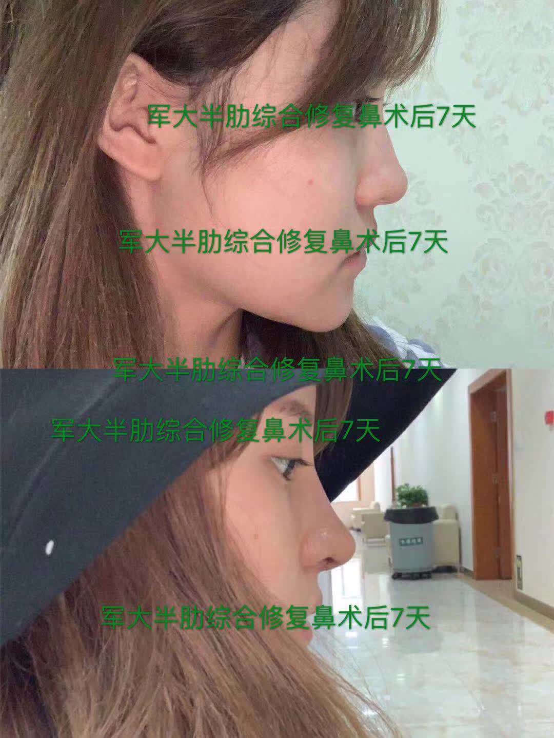 廣州中家醫(yī)家庭醫(yī)生整形醫(yī)院：五代SMAS提升除皺術(shù)