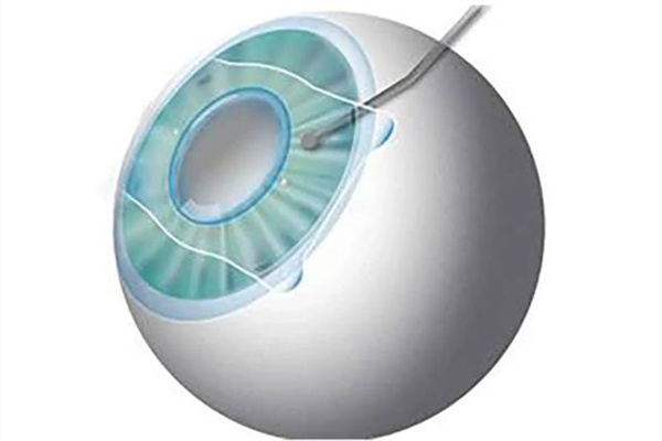 合肥維視眼科和科大眼科哪家好？從口碑、技術多維度對比，近視矯正與疑難眼病各有優(yōu)選！ 