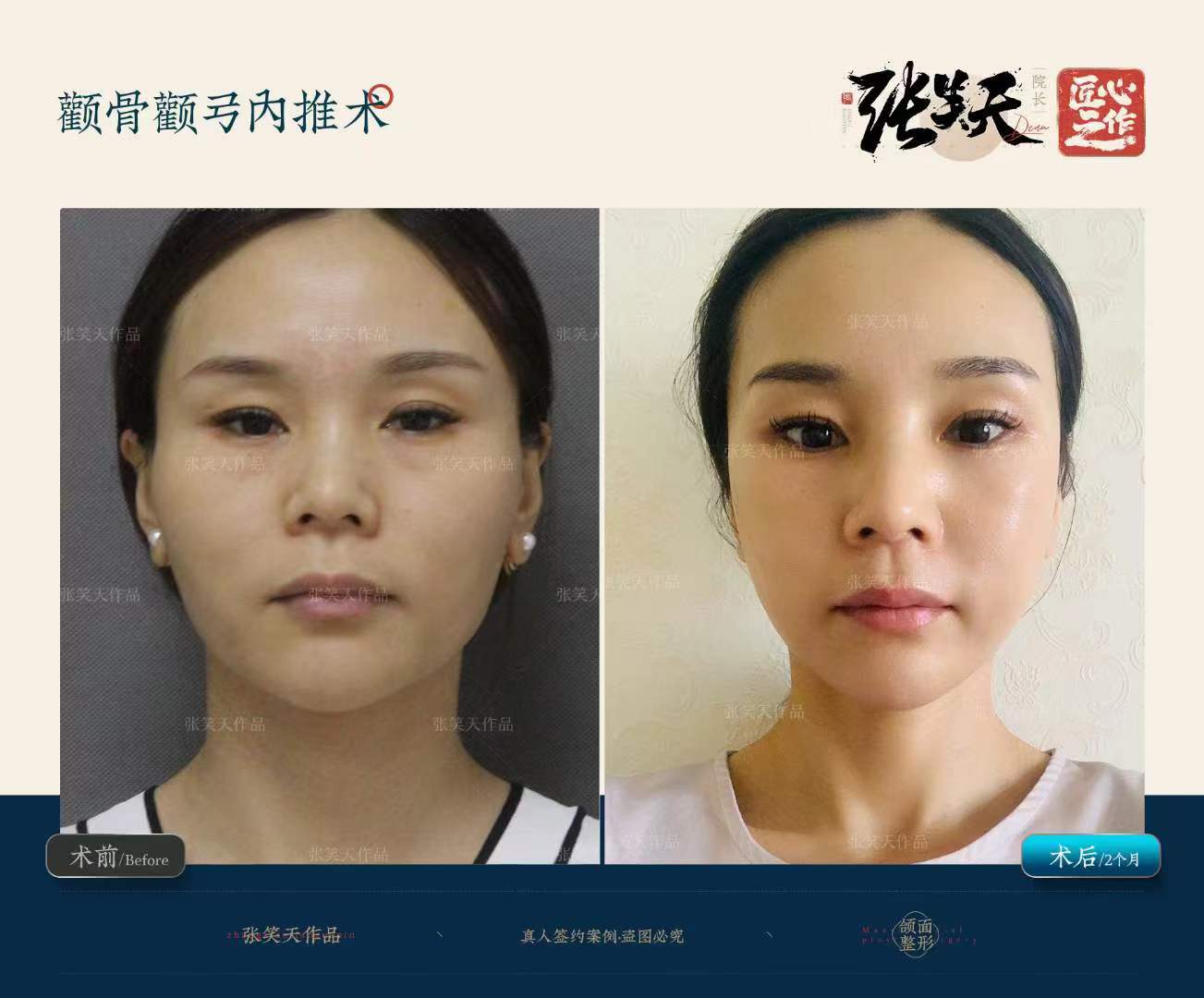 一、廈門磨骨手術(shù)費價格表2026