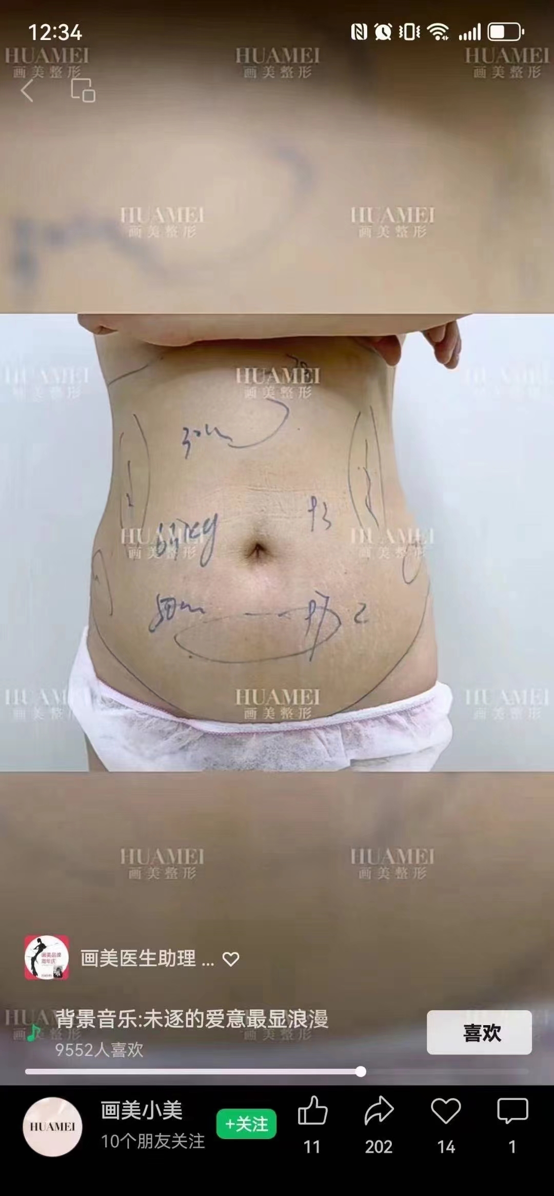 一、王世虎吸脂技術真的厲害嗎