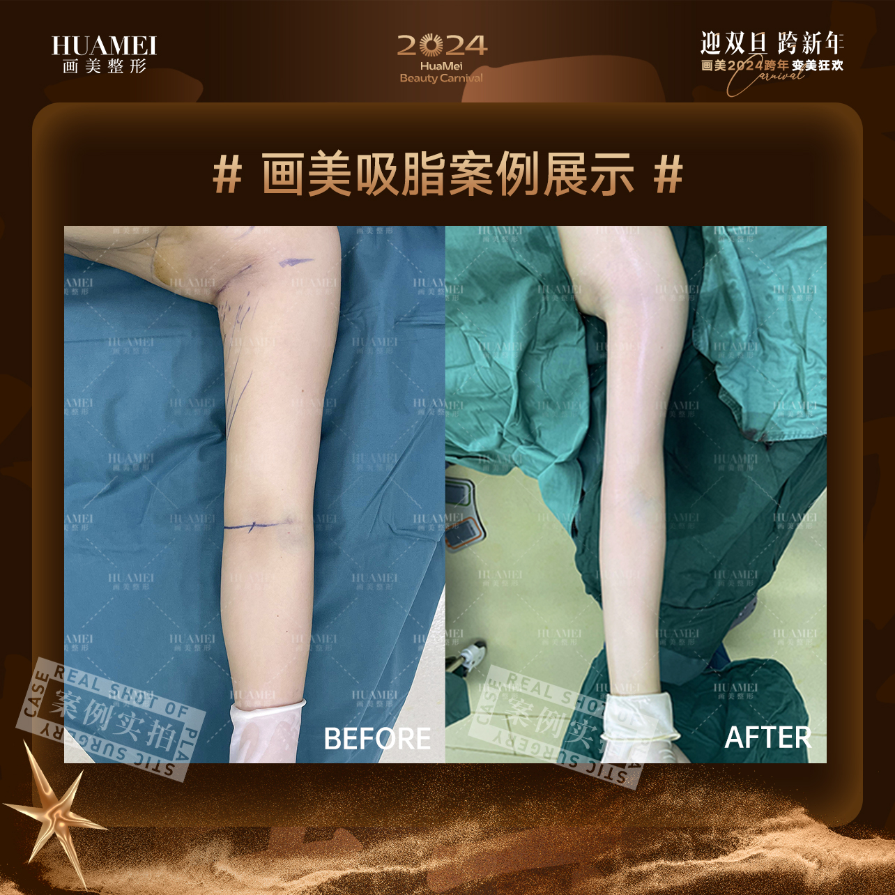 四、廣州軍美王世虎吸脂技術的患者反饋