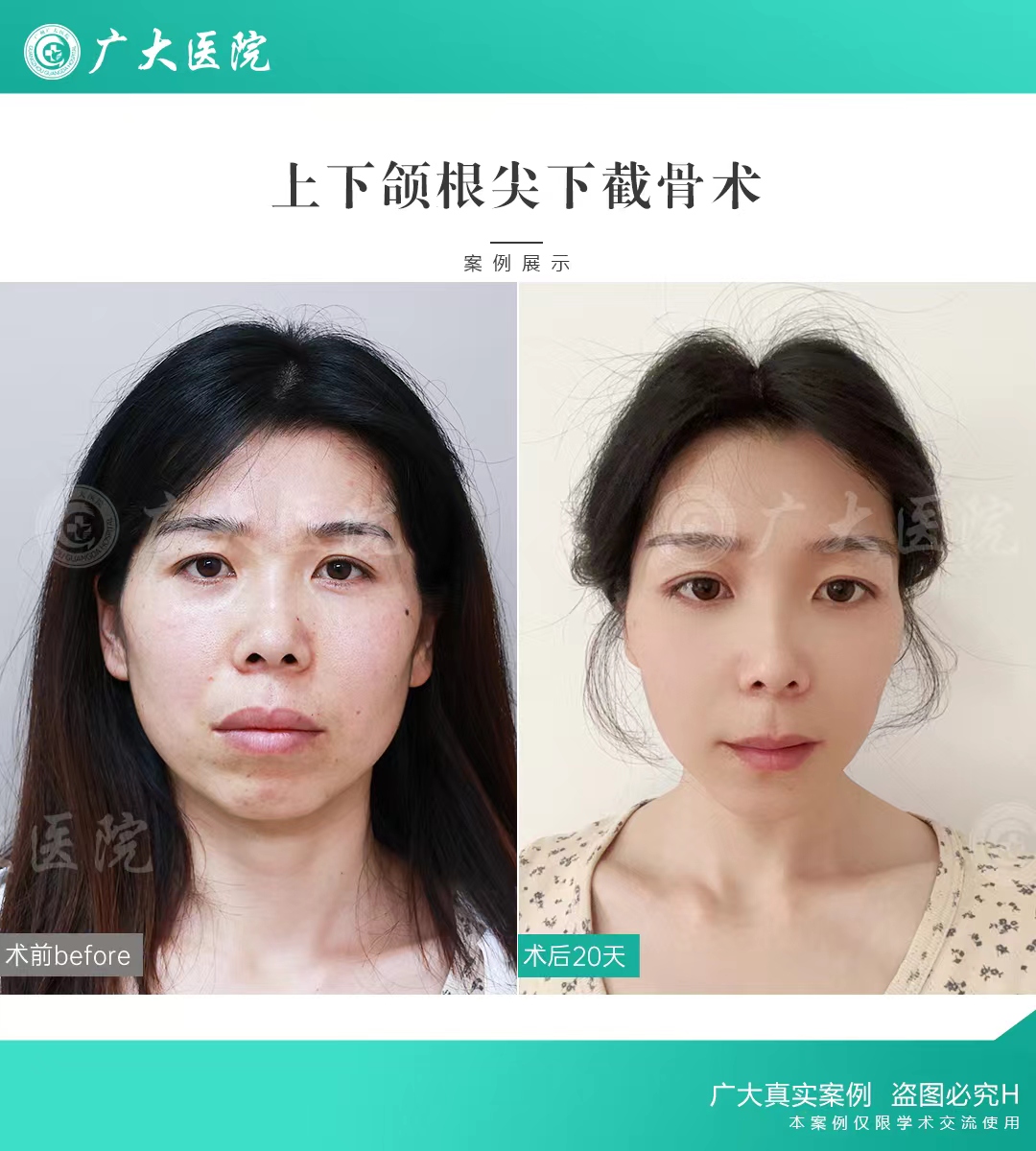 二、廈門海峽整形美容醫(yī)院的磨骨優(yōu)勢