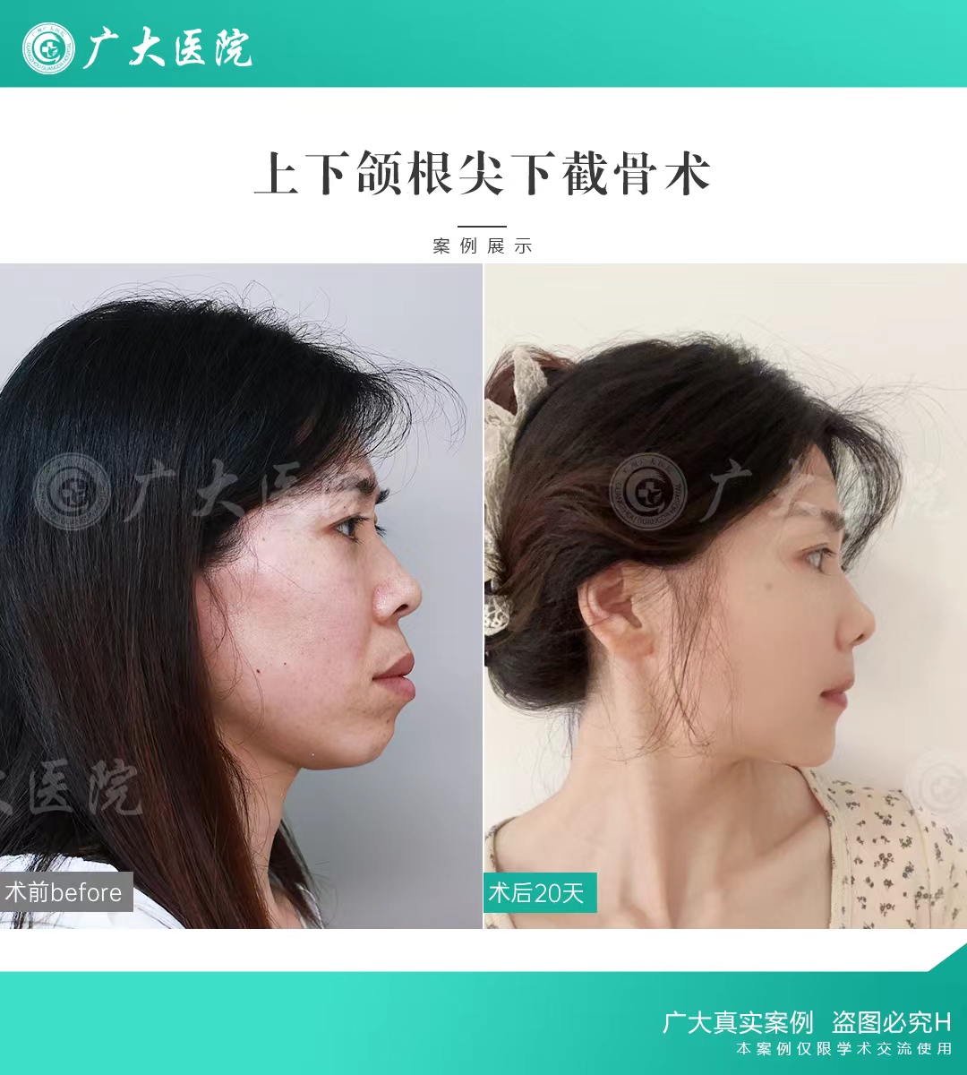 三、廈門美萊醫(yī)療美容醫(yī)院的磨骨特色