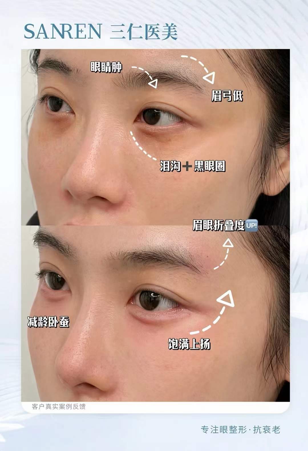 修復(fù)期與護(hù)理要點(diǎn)