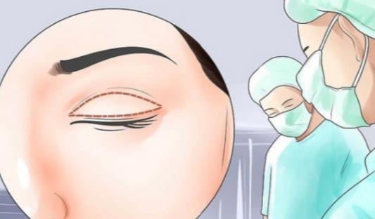 六、面診必備：問了這幾個問題，你才能自己判斷高壽松和陳海華誰眼修復更好