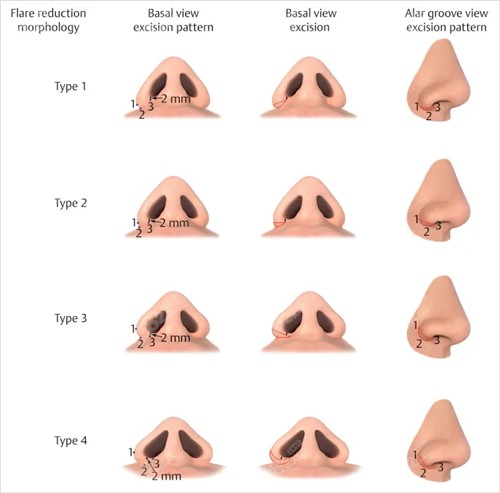 不同鼻子縮小鼻翼對比圖