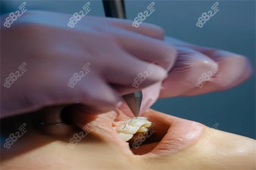 牙齒矯正操作中