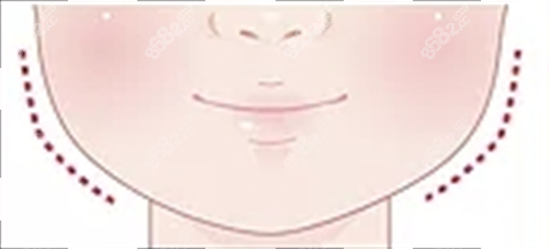 適合打玻尿酸面部輪廓