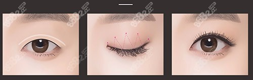 埋線雙眼皮過程示意圖