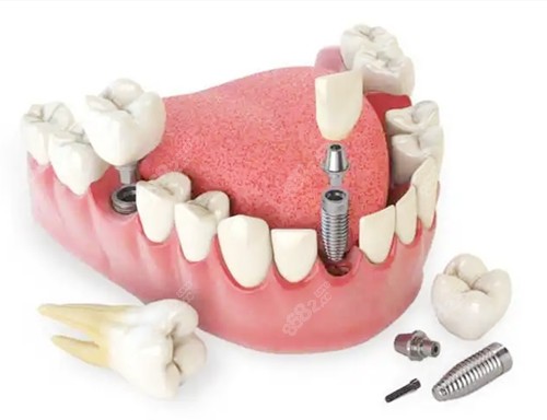 種植牙3D模型圖