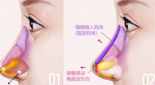 鼻尖假體植入位置