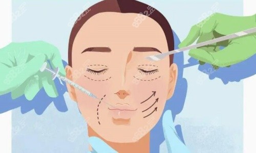 雙眼皮手術(shù)操作示意圖