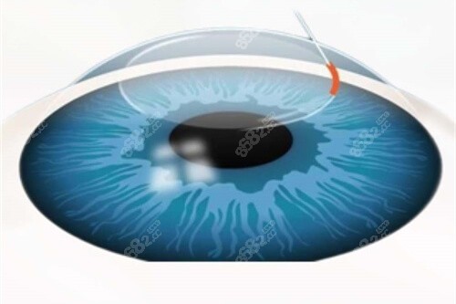 近視矯正眼球漫畫示意圖