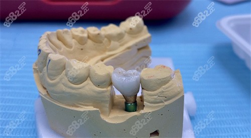 白山種植牙哪家牙科口碑好？這幾家不僅種牙技術(shù)硬，術(shù)后服務(wù)也更到位