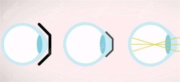 近視矯正過程中眼球的變化圖解