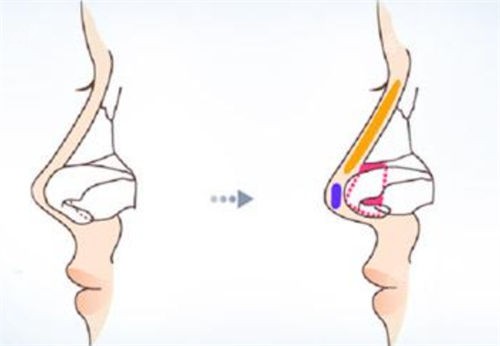 鼻尖鼻梁隆鼻手術(shù)前后對比圖