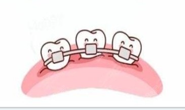 隱形牙齒和傳統(tǒng)牙齒矯正器展示圖