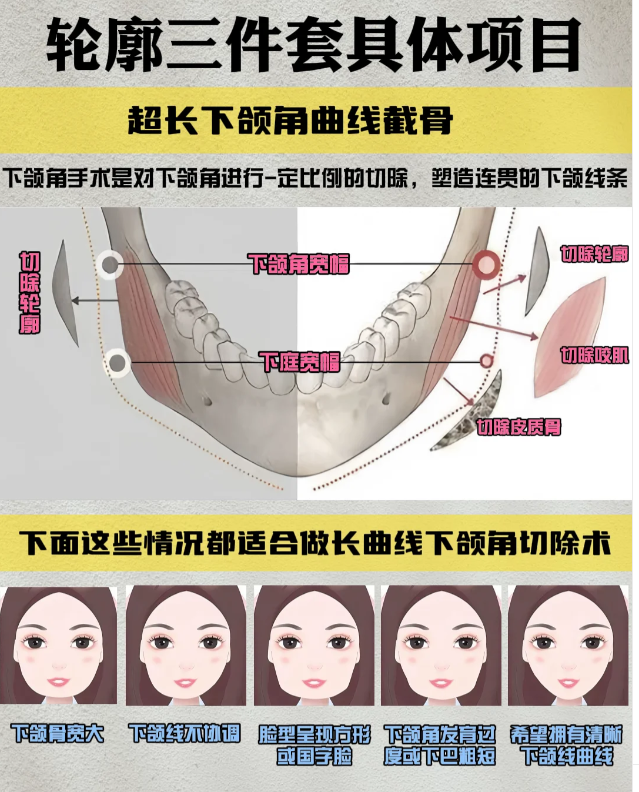 五、下颌角手术修复大小脸的原理